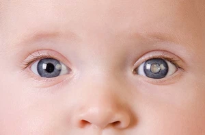 congenital cataract eye doctor cambridge